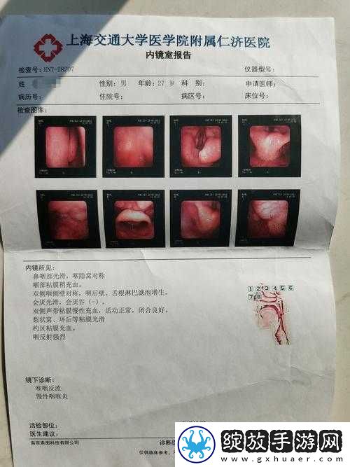 医院计划喉炎什么症状